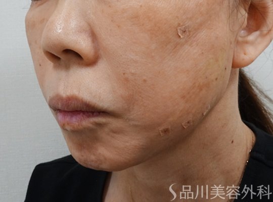 症例NO.71757のAFTER写真