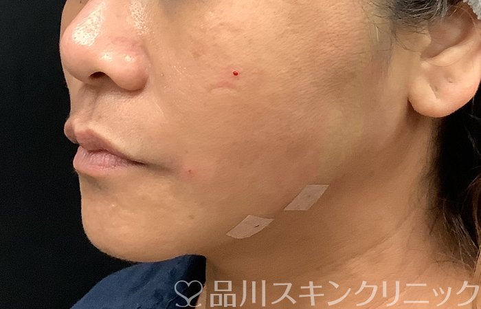 症例NO.69378のAFTER写真