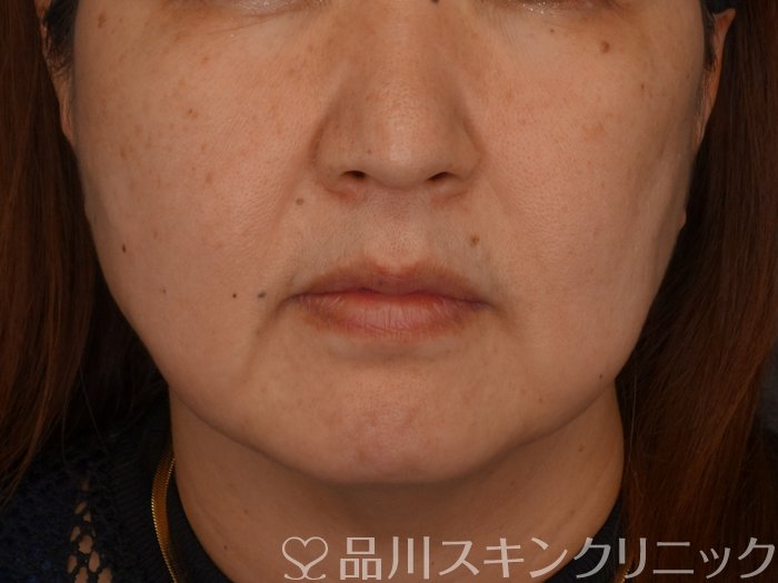 症例NO.75278のBEFORE写真