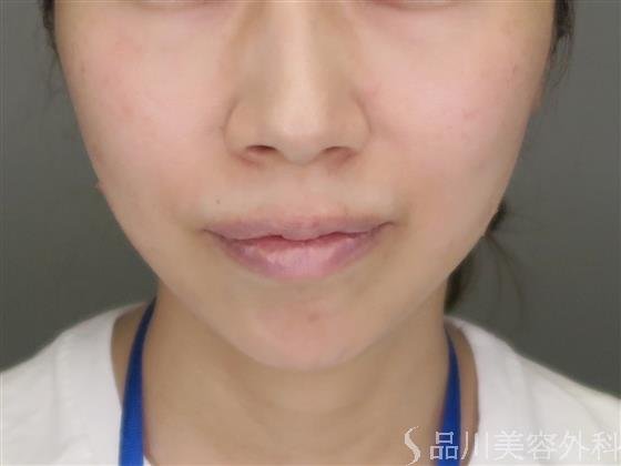 症例NO.47151のAFTER写真