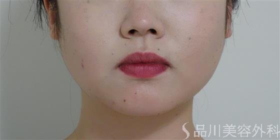 症例NO.51938のBEFORE写真