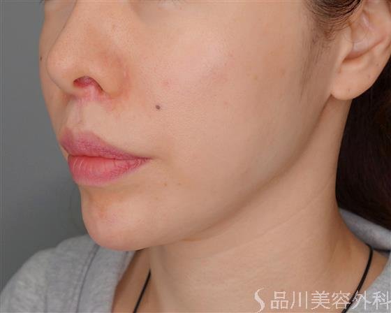 症例NO.54929のBEFORE写真