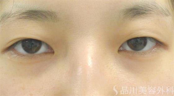症例NO.39968のBEFORE写真