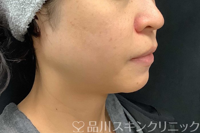 症例NO.69519のBEFORE写真
