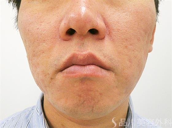 症例NO.30849のAFTER写真