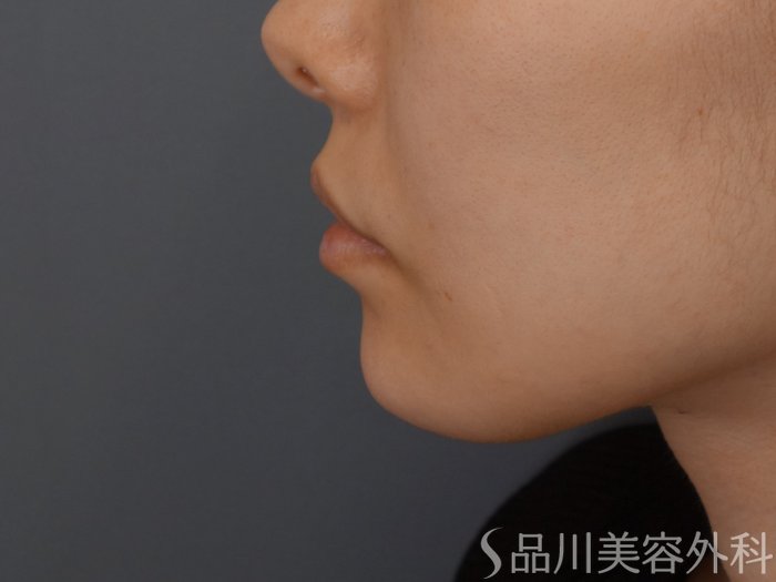 症例NO.69549のAFTER写真