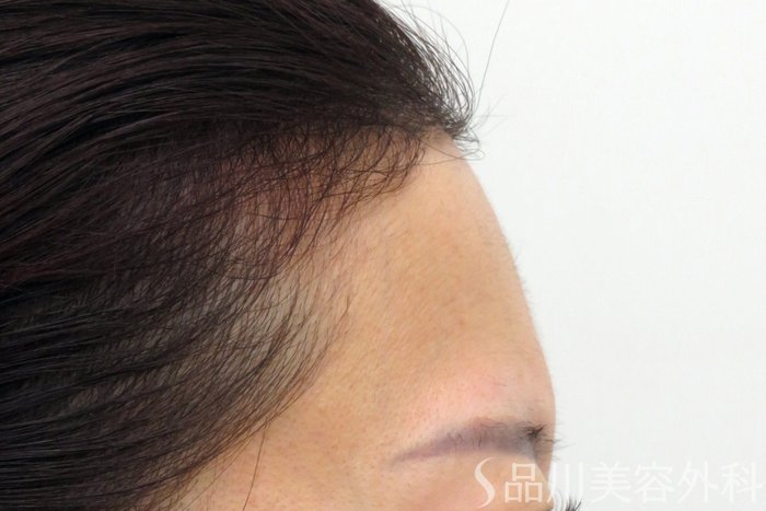 症例NO.75302のBEFORE写真