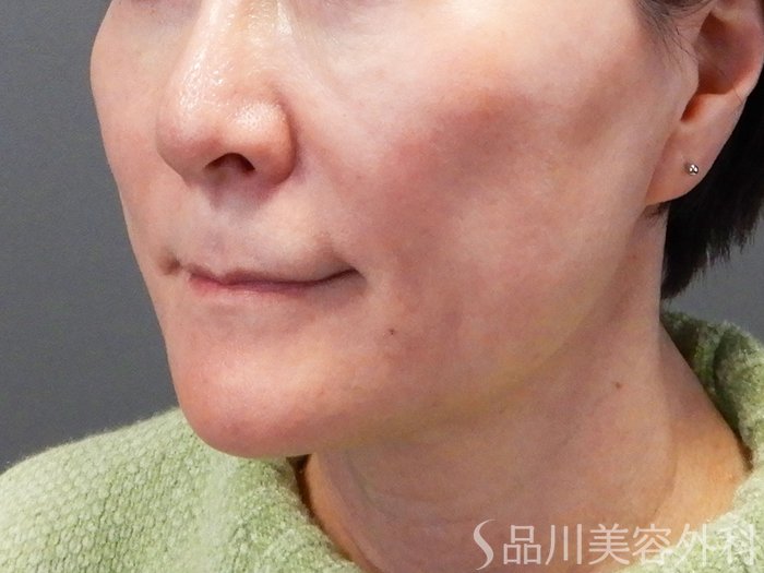 症例NO.73269のAFTER写真