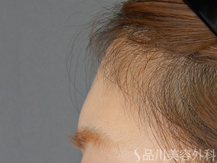 症例NO.72860のBEFORE写真