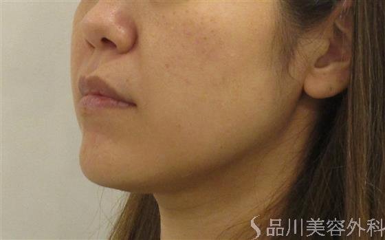 症例NO.60999のBEFORE写真
