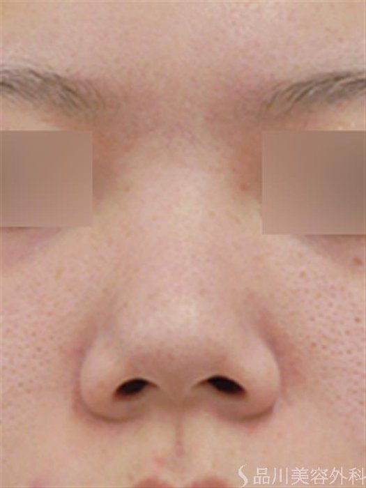 症例NO.40843のBEFORE写真