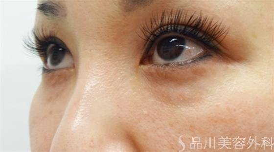 症例NO.40665のBEFORE写真