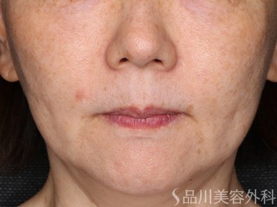 症例NO.72911のBEFORE写真