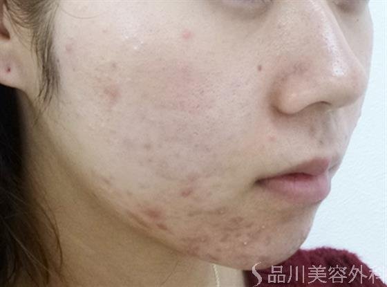 症例NO.24281のBEFORE写真