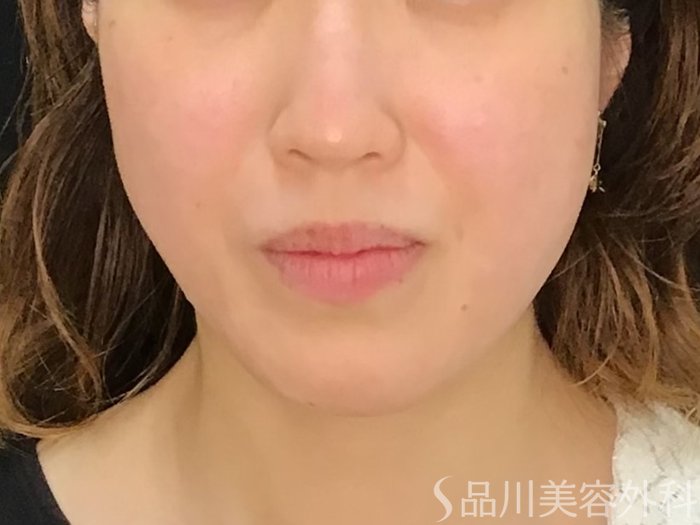 症例NO.71553のBEFORE写真