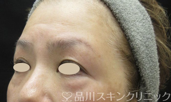 症例NO.69364のBEFORE写真