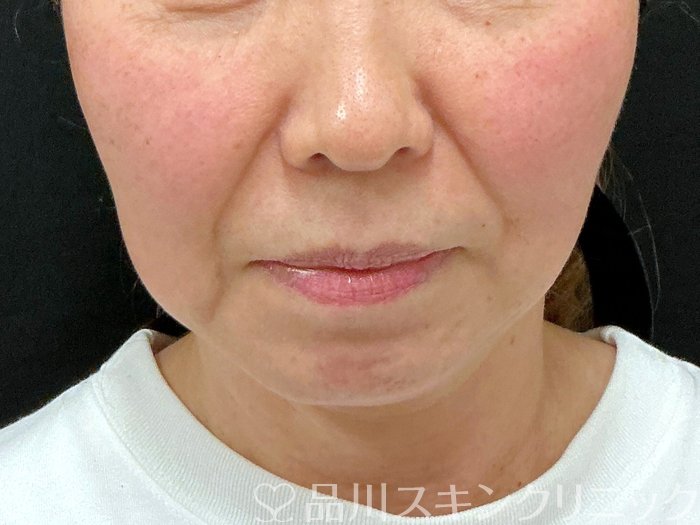 症例NO.74938のBEFORE写真