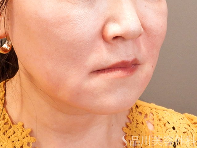 症例NO.70073のAFTER写真
