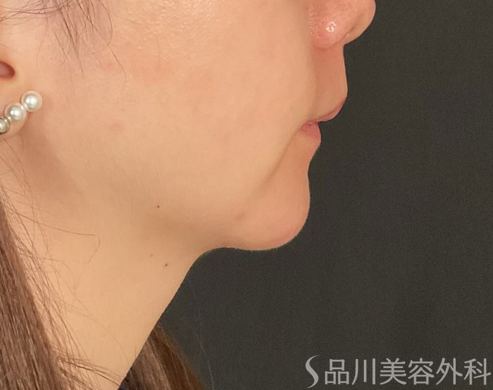 症例NO.74906のBEFORE写真
