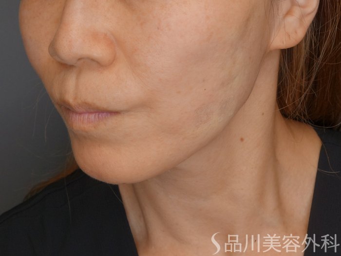 症例NO.71072のAFTER写真