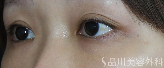 症例NO.72508のBEFORE写真