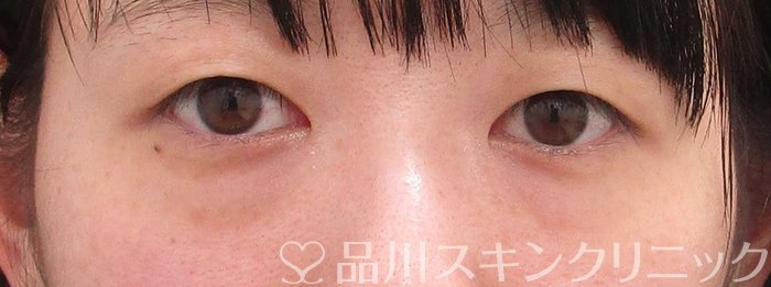 症例NO.63578のBEFORE写真