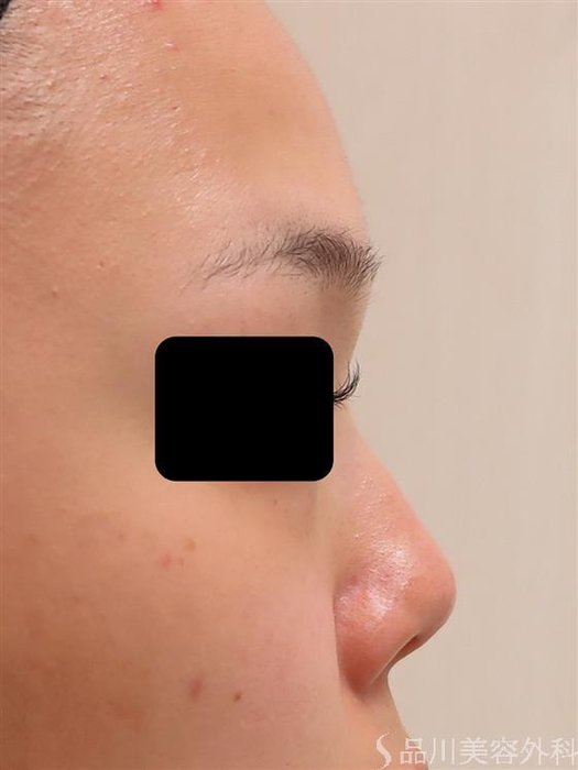 症例NO.45564のBEFORE写真