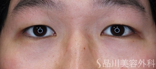 症例NO.64949のBEFORE写真