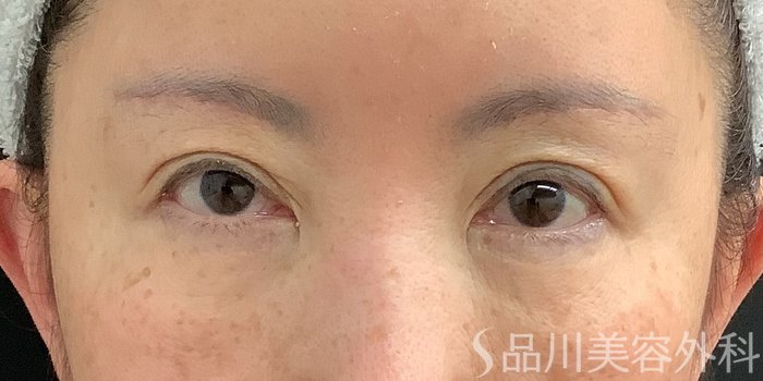 症例NO.73319のAFTER写真