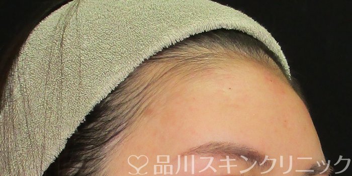 症例NO.67994のAFTER写真