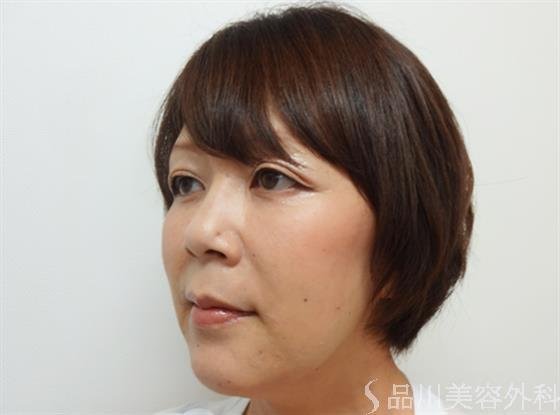 症例NO.26665のAFTER写真
