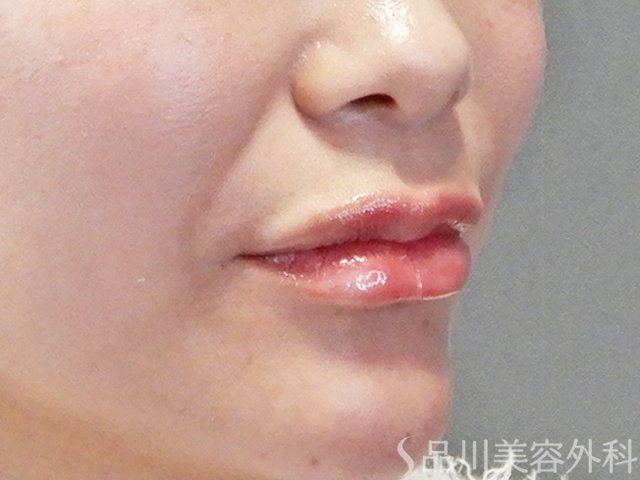 症例NO.67708のAFTER写真