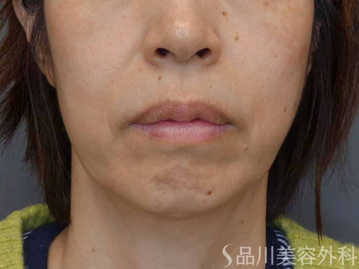 症例NO.72872のBEFORE写真