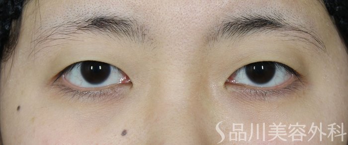 症例NO.65223のBEFORE写真