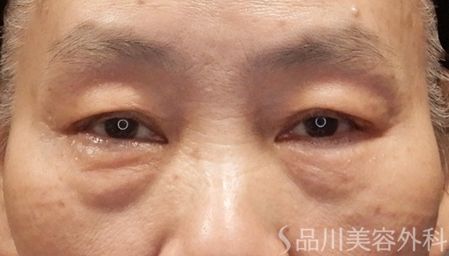 症例NO.74809のBEFORE写真