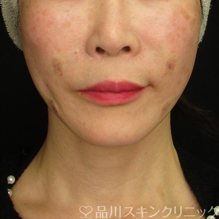 症例NO.70188のAFTER写真