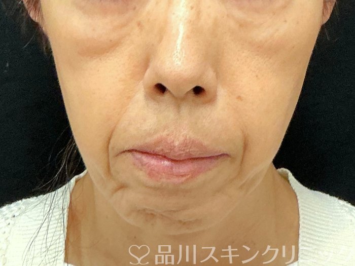 症例NO.74000のBEFORE写真