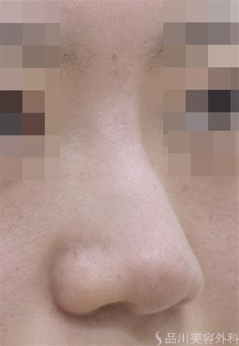症例NO.47698のBEFORE写真