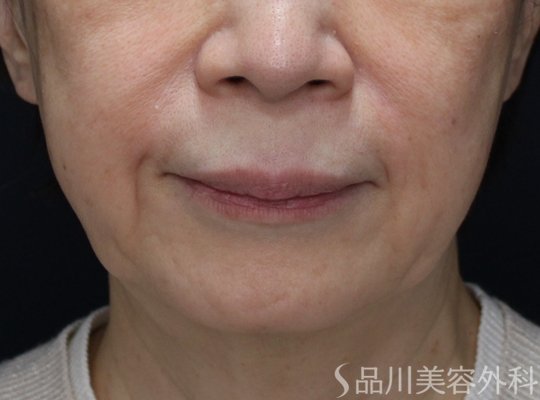 症例NO.74586のBEFORE写真