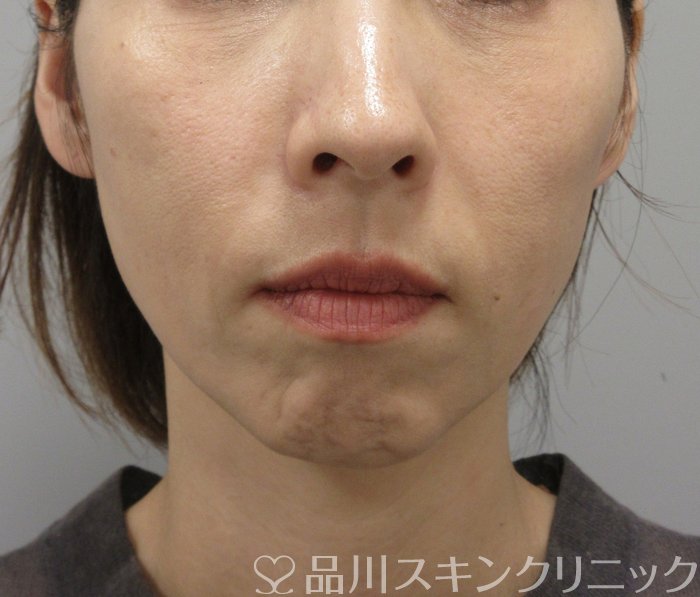 症例NO.74366のAFTER写真