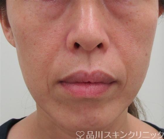 症例NO.31214のBEFORE写真