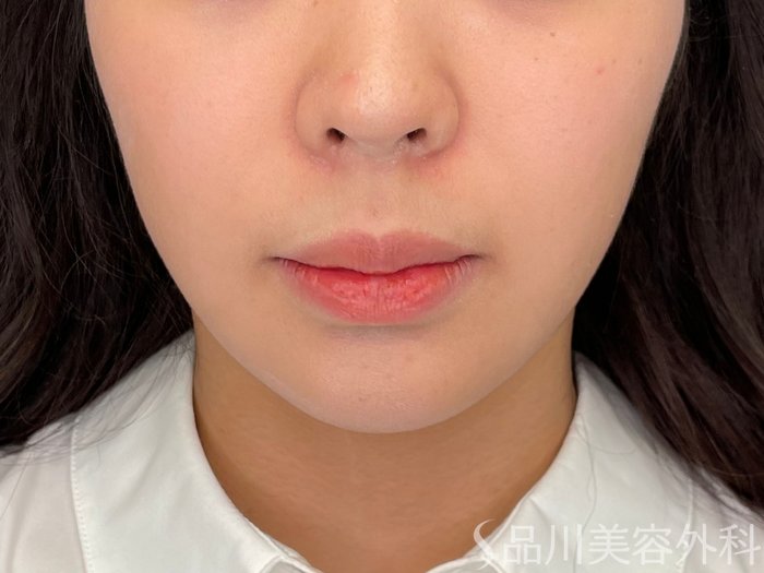 症例NO.73412のBEFORE写真