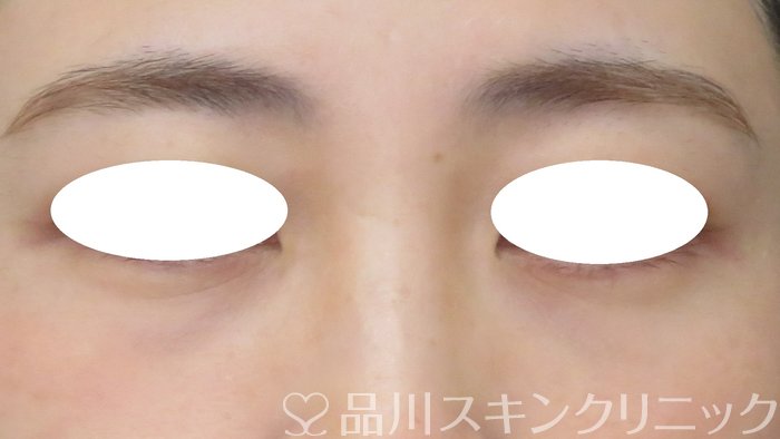 症例NO.70430のBEFORE写真