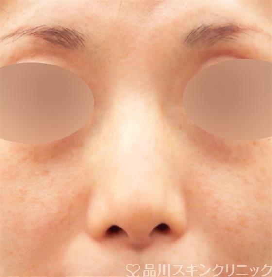 症例NO.54350のBEFORE写真