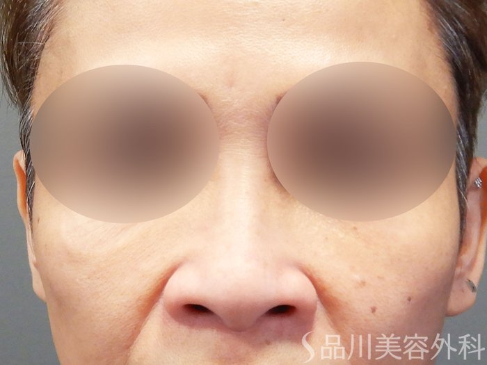症例NO.74188のBEFORE写真