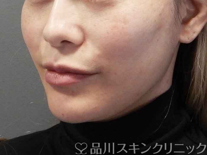 症例NO.72852のAFTER写真