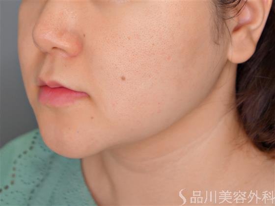 症例NO.55083のBEFORE写真