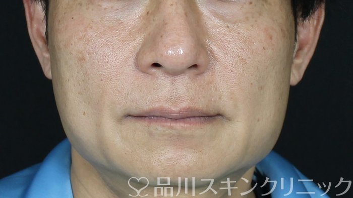 症例NO.71192のAFTER写真
