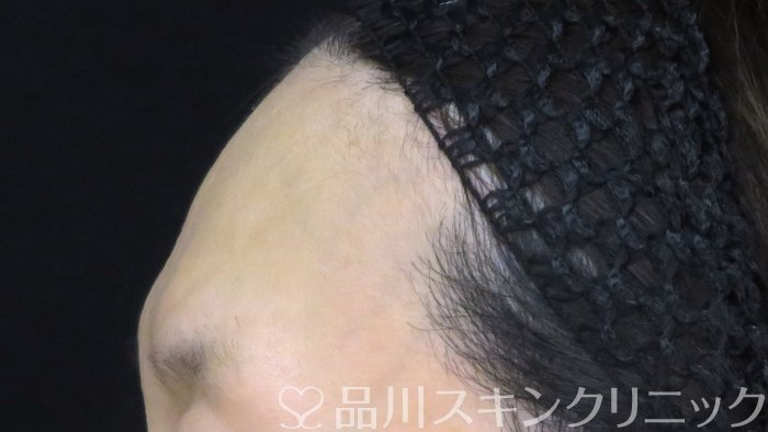 症例NO.71331のBEFORE写真