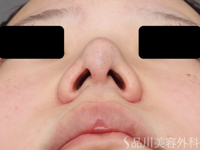 症例NO.71071のAFTER写真